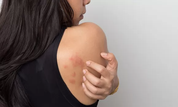 Qué causa la dermatitis seborreica y quiénes tienen más riesgo? - América  Noticias