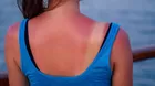 Tengo la piel roja por el Sol: ¿Qué debo hacer?