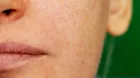 ¿Cómo reducir los poros abiertos en el rostro?