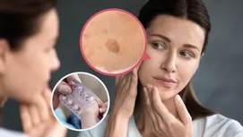 Seis remedios naturales que prometen quitar las manchas de la cara