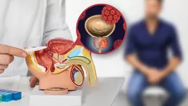 Próstata inflamada: ¿Por qué afecta a hombre en abstinencia?