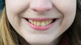 ¿Cómo evitar los dientes chuecos y una mala mordida en tus hijos?