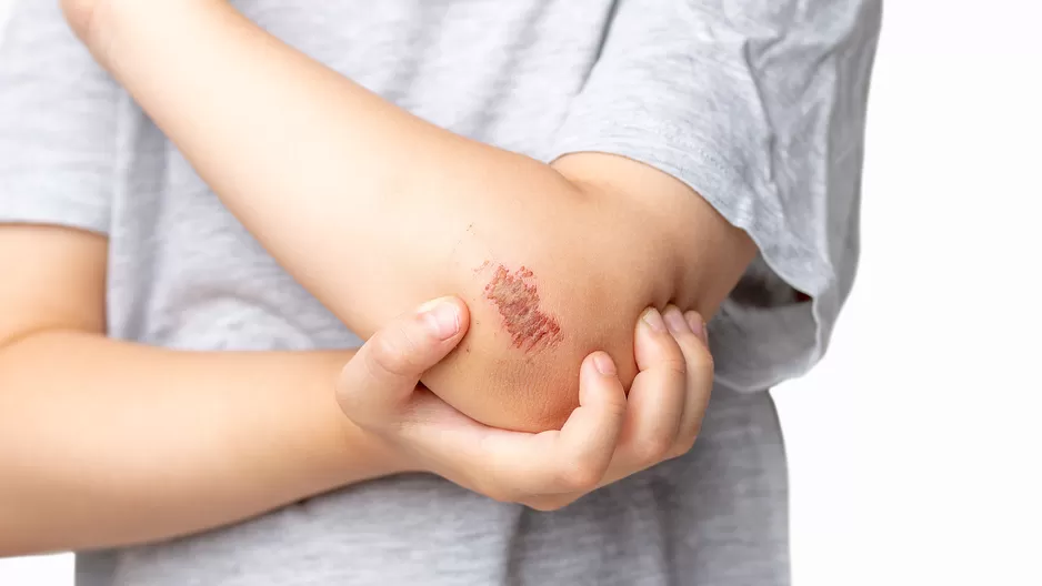 ¿Por qué debes dejar de sacarte las costras de tus heridas? ¿Por qué debes dejar de sacarte las costras de tus heridas?