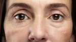¿Cuál es la causa de que se formen bolsas en los ojos?