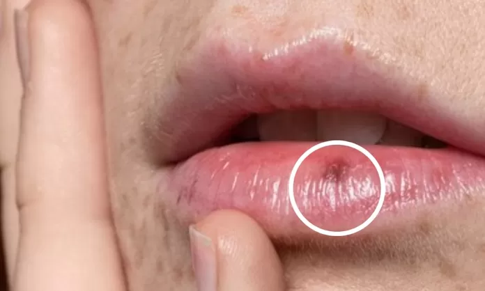 Manchas en los labios que son oscuras: Las causas a evitar
