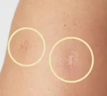 Conoce cómo se aplica una vacuna para que deje tal marca. (Foto: Útil e Interesante)