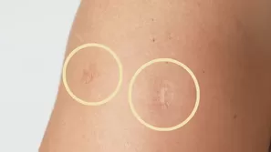 Conoce cómo se aplica una vacuna para que deje tal marca. (Foto: Útil e Interesante)