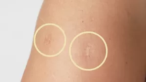 Conoce cómo se aplica una vacuna para que deje tal marca. (Foto: Útil e Interesante)