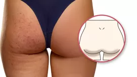 Foliculitis en los glúteos: causas y cómo evitarlo