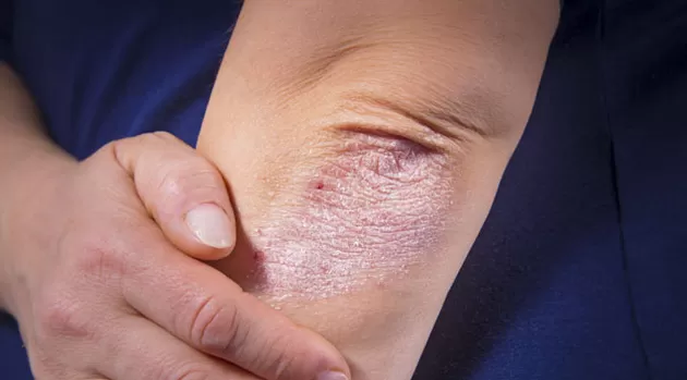 ¿Por qué las personas con psoriasis deben evitar el estrés?
