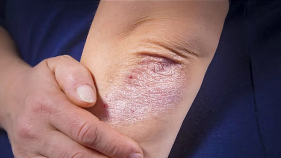 Consejos para elevar la calidad de vida de los pacientes con psoriasis (Foto: Shutterstock)