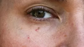 ¿Por qué aparecen estos puntitos blancos en tu piel?