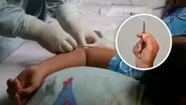 Implante anticonceptivo: ¿Cómo funciona y cuán efectivo es?