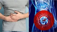 ¿Qué es la diverticulitis y cuándo se hace cirugía en el colon?