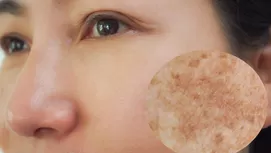 ¿Por qué salen manchas en las manos y cómo eliminarlas?