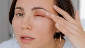 ¿Qué diferencia hay entre un chalazión y orzuelo?