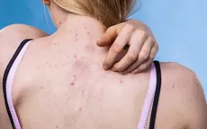 ¿Por qué tienes estos granos en la espalda y cómo eliminarlos? - Noticias de cuidado-piel