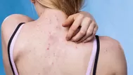 ¿Por qué tienes estos granos en la espalda y cómo eliminarlos?