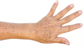 ¿Por qué salen estas manchas blancas en la piel?