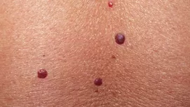 ¿Por qué salen lunares rojos en la piel?