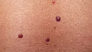Puntos rojos en el cuerpo: por qué salen y cómo eliminarlos