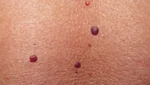 Especialistas recomiendan cómo eliminar esos puntitos rojos en tu piel