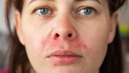 ¿Qué causa la dermatitis seborreica y quiénes tienen más riesgo?