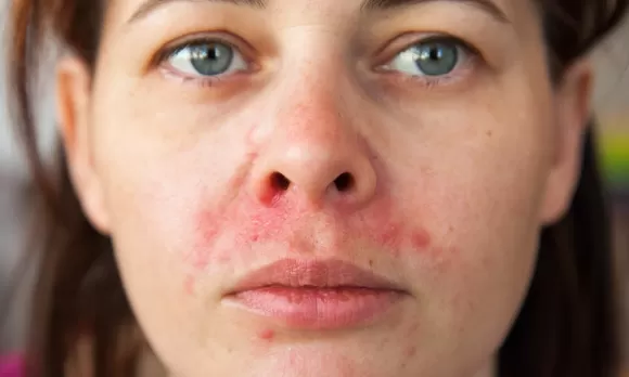 Por qué se produce la dermatitis seborreica? Tratamiento