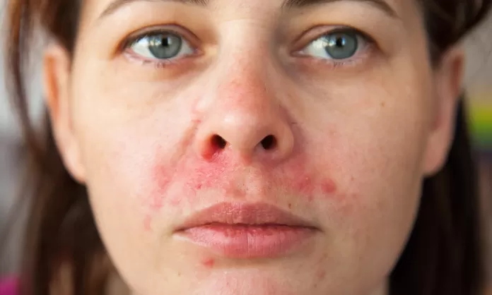 Qué causa la dermatitis seborreica y quiénes tienen más riesgo? - América