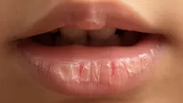 Causas de los labios resecos