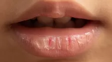 Causas de los labios resecos