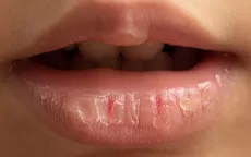 ¿Por qué se resecan tus labios y cómo mantenerlos hidratados? - Noticias de martha-chavez