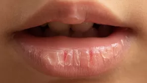 Causas de los labios resecos