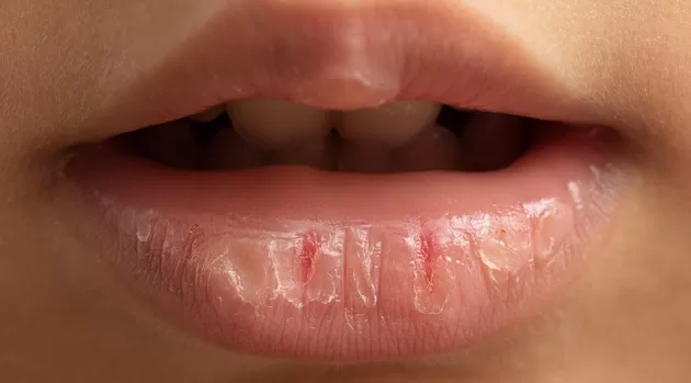 ¿Por qué se resecan tus labios y cómo mantenerlos hidratados?