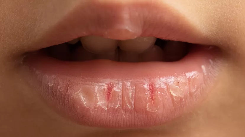 &iquest;Por qu&eacute; se resecan tus labios y c&oacute;mo mantenerlos hidratados?