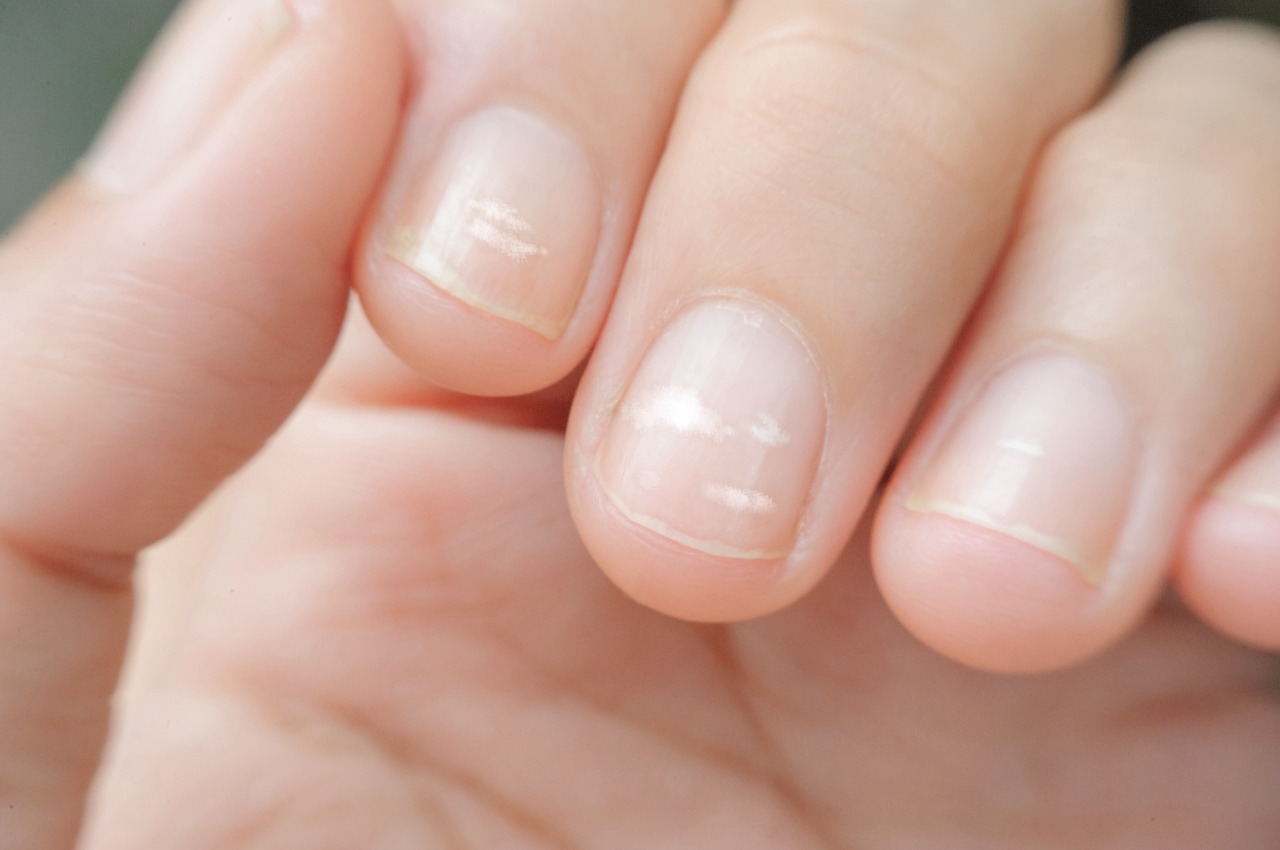 Manchas blancas en las uñas