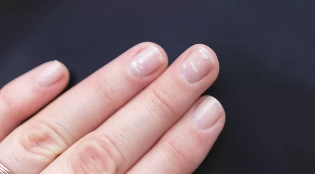 ¿Qué hábitos y accidentes te provocan manchas blancas en tus uñas?