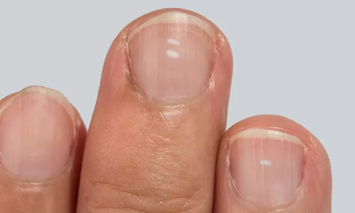 Rubí Ten cuidado Abastecer Qué significan las manchas en las uñas y cuándo debes preocuparte? -  América Noticias