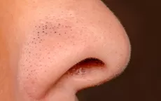 ¿Qué son esos puntos negros en tu nariz y por qué no puedes quitarlos? - Noticias de cuidado-piel