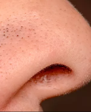 ¿Qué son esos puntos negros en tu nariz y por qué no puedes quitarlos?