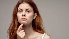 ¿Por qué aparecen estos puntitos blancos en tu piel?