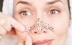 ¿Por qué te salen puntos negros en el rostro y cómo eliminarlos? - Noticias de yailin-la-mas-viral