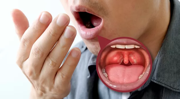 ¿Tienes mal aliento? Unas bolitas en tus amígdalas pueden ser la causa