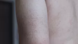 Estrías blancas y rojas: por qué salen y cuáles se pueden eliminar