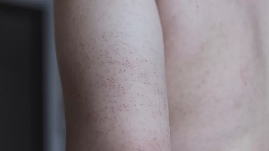 Lo que debes saber sobre la queratosis pilaris