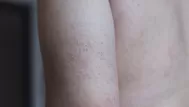 Queratosis pilaris: ¿Por qué aparecen granitos en los brazos?