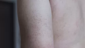 Lo que debes saber sobre la queratosis pilaris
