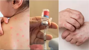 ¿Qué pasa con un caso grave de sarampión y quiénes están en riesgo?