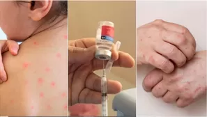 ¿Qué pasa con un caso grave de sarampión y quiénes están en riesgo?