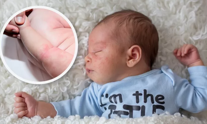 Sarpullido en bebés y niños: sus causas y tratamientos